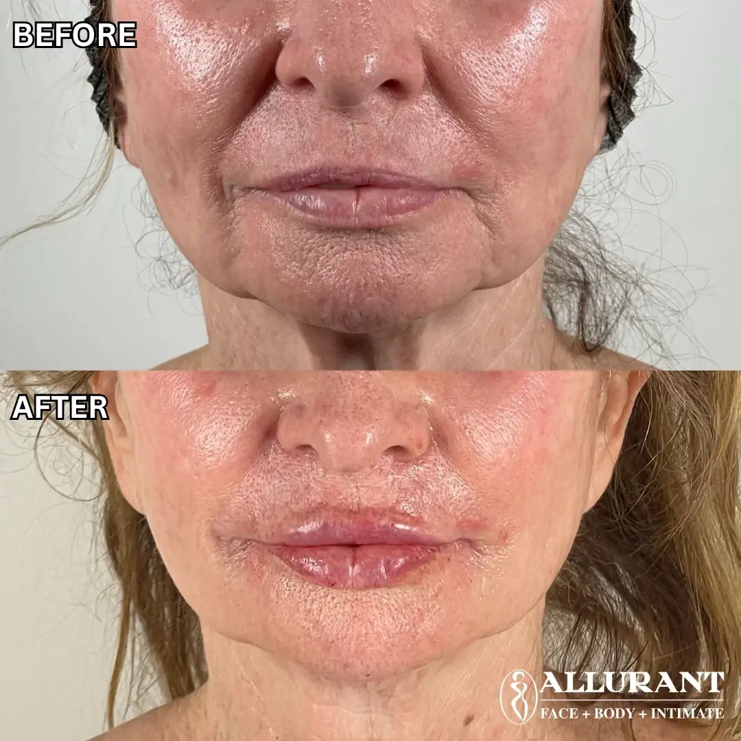 Allurant Medical Spa lip filler result — San Diego, CA