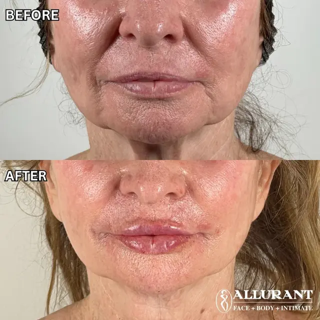 Lip Filler result at Allurant Medical Spa in San Diego, CA