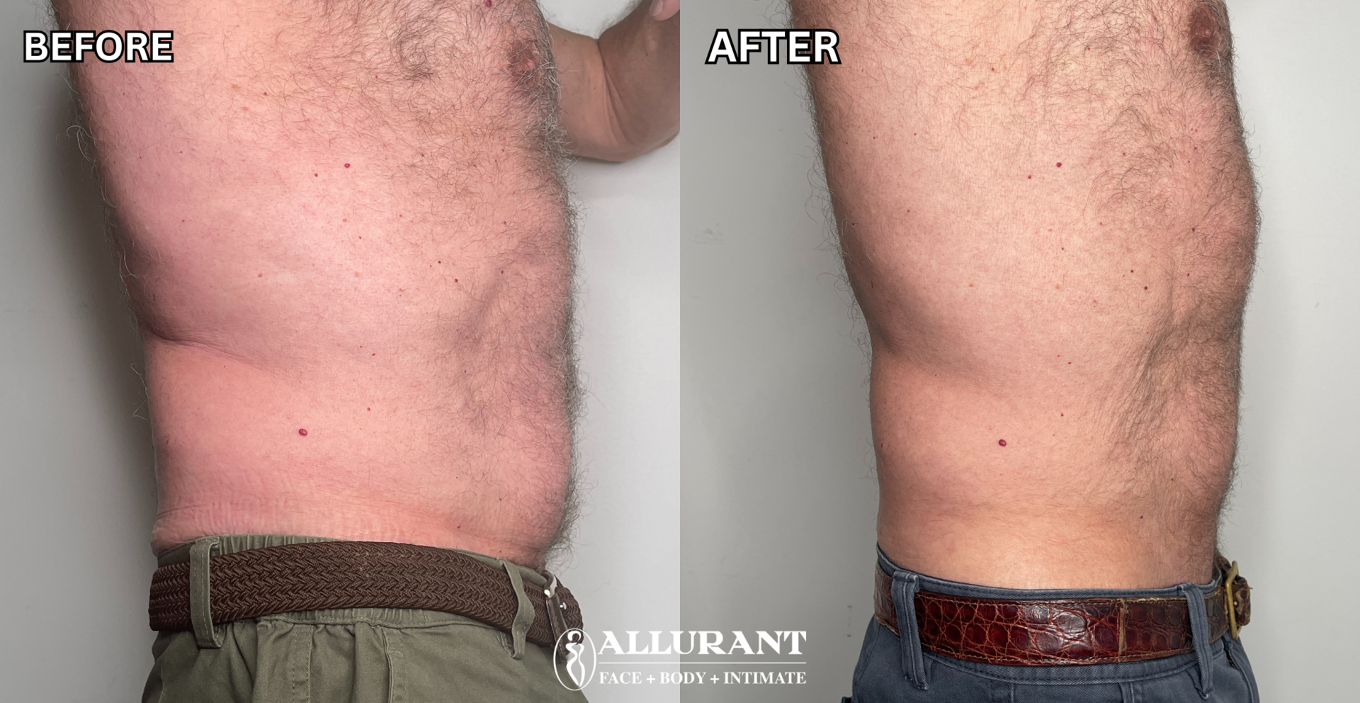 Allurant Medical Spa result — San Diego, CA