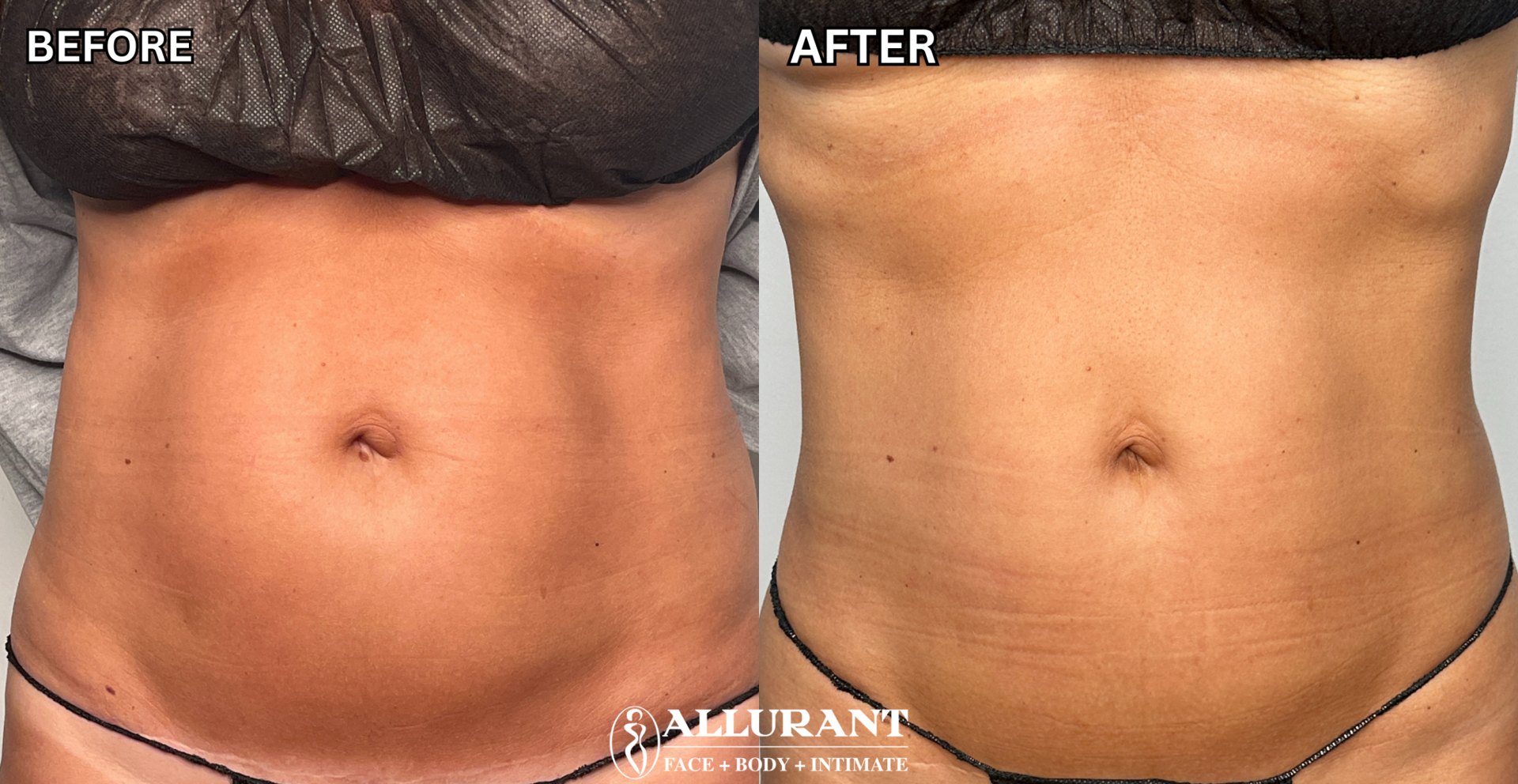 Allurant Medical Spa result — San Diego, CA