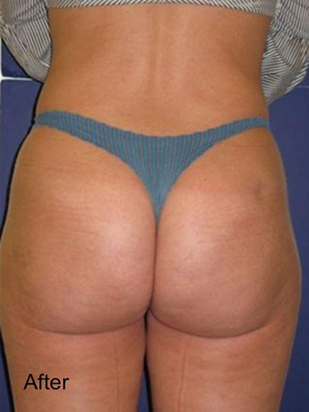 Brazilian Butt Lift after at Beverly Hills Aesthetics in Los Angeles, CA