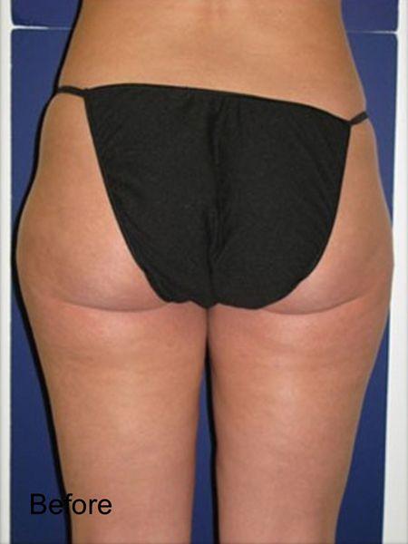 Brazilian Butt Lift before at Beverly Hills Aesthetics in Los Angeles, CA