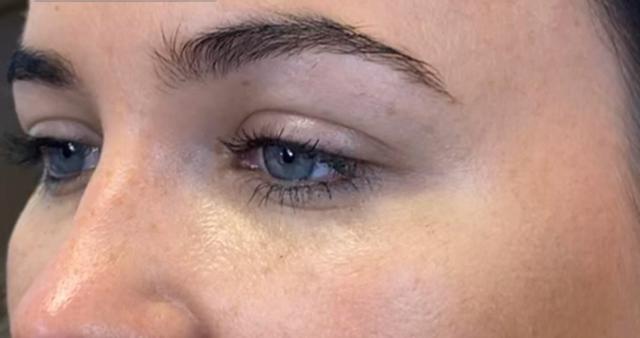 Brow Lift before at Beverly Hills Aesthetics in Los Angeles, CA
