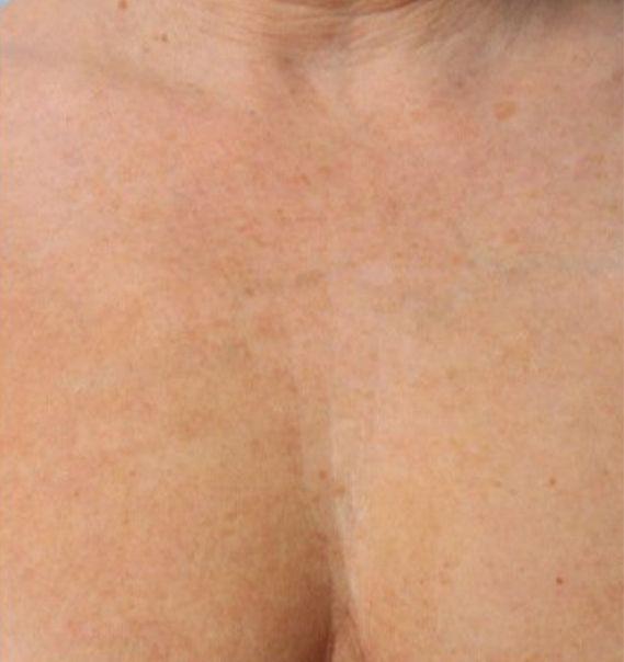 Botox after at Beverly Hills Aesthetics in Los Angeles, CA