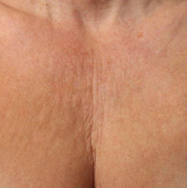 Botox before at Beverly Hills Aesthetics in Los Angeles, CA