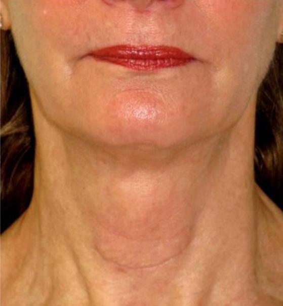 Botox after at Beverly Hills Aesthetics in Los Angeles, CA