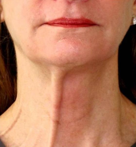 Botox before at Beverly Hills Aesthetics in Los Angeles, CA