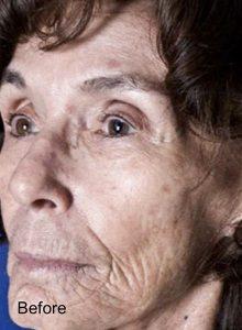 Laser Skin Resurfacing before at Beverly Hills Aesthetics in Los Angeles, CA