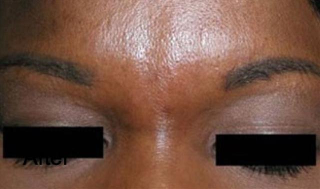 Botox after at Beverly Hills Aesthetics in Los Angeles, CA