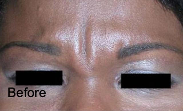Botox before at Beverly Hills Aesthetics in Los Angeles, CA