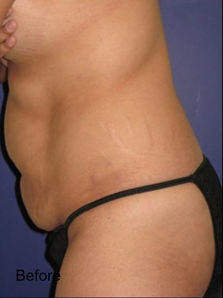 Tummy Tuck before at Beverly Hills Aesthetics in Los Angeles, CA