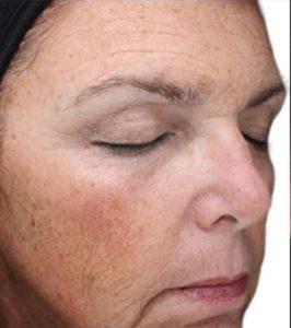 Chemical Peel before at Beverly Hills Aesthetics in Los Angeles, CA