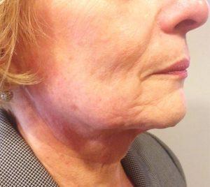 Beverly Hills Aesthetics skin tightening after — Los Angeles, CA