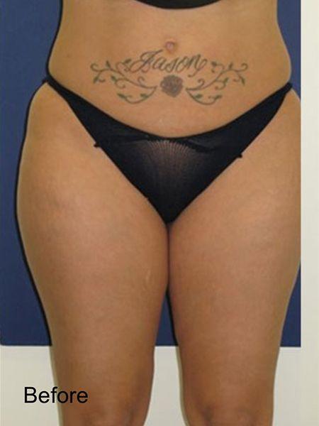 Liposuction before at Beverly Hills Aesthetics in Los Angeles, CA