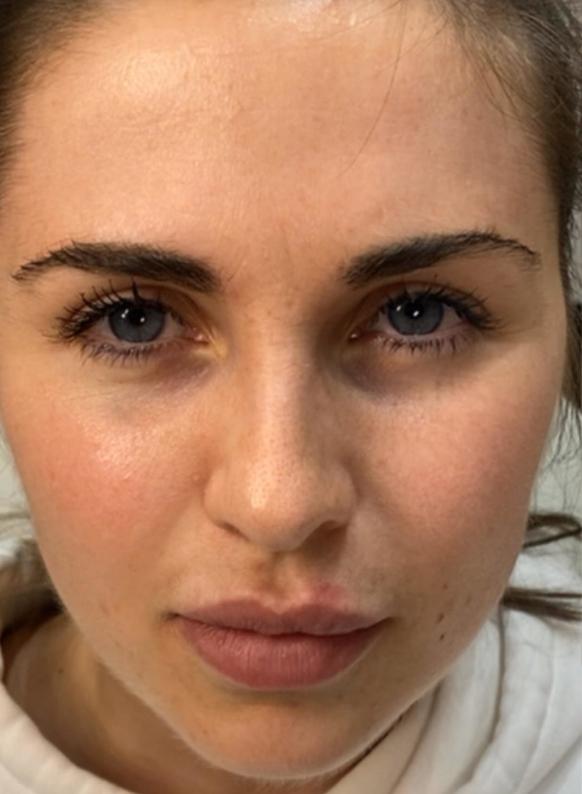 Brow Lift before at Beverly Hills Aesthetics in Los Angeles, CA
