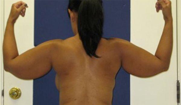 Breast Lift before at Beverly Hills Aesthetics in Los Angeles, CA
