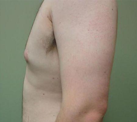Gynecomastia Surgery after at Beverly Hills Aesthetics in Los Angeles, CA
