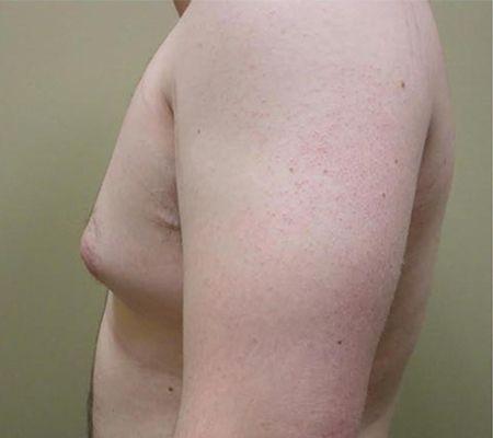 Gynecomastia Surgery before at Beverly Hills Aesthetics in Los Angeles, CA