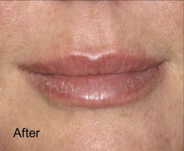 Lip Filler after at Beverly Hills Aesthetics in Los Angeles, CA