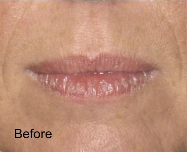Lip Filler before at Beverly Hills Aesthetics in Los Angeles, CA