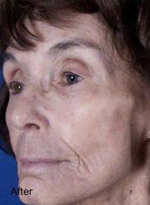 Laser Skin Resurfacing after at Beverly Hills Aesthetics in Los Angeles, CA
