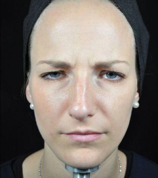 Botox after at Beverly Hills Aesthetics in Los Angeles, CA