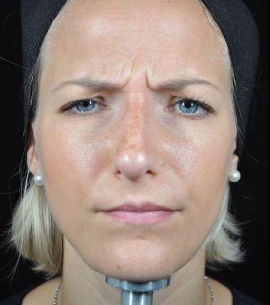 Botox before at Beverly Hills Aesthetics in Los Angeles, CA