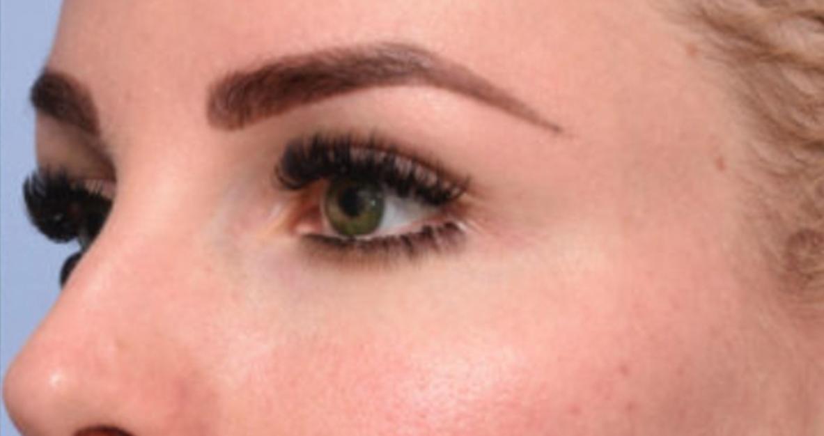 Beverly Hills Aesthetics brow lift result — Los Angeles, CA