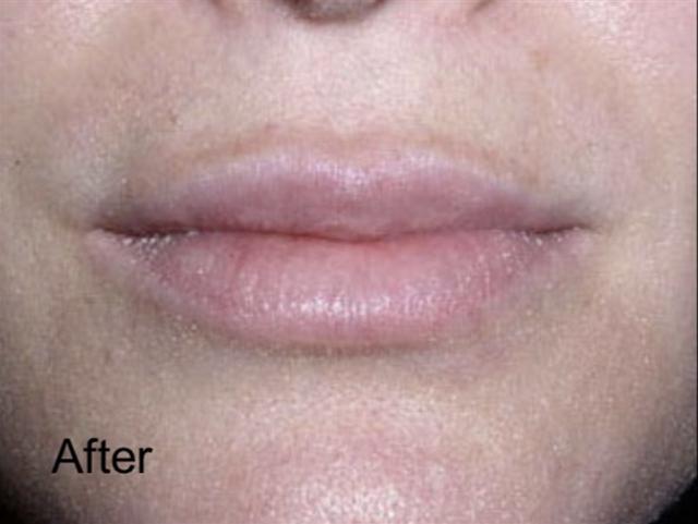 Lip Filler after at Beverly Hills Aesthetics in Los Angeles, CA