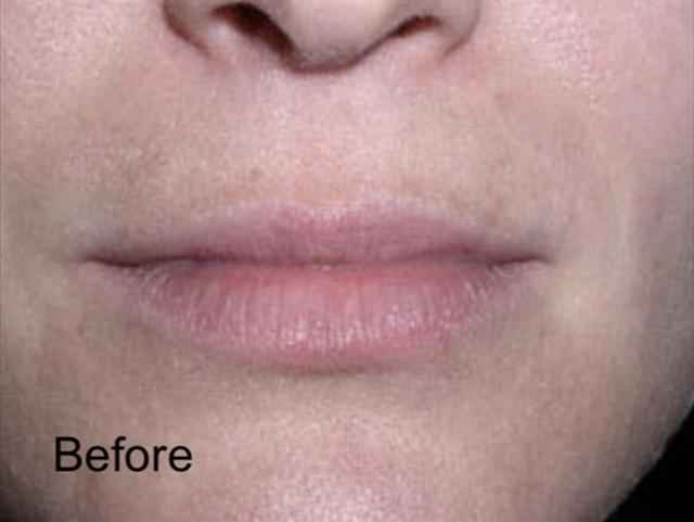 Lip Filler before at Beverly Hills Aesthetics in Los Angeles, CA