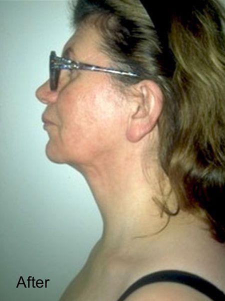 Deep Plane Facelift after at Beverly Hills Aesthetics in Los Angeles, CA
