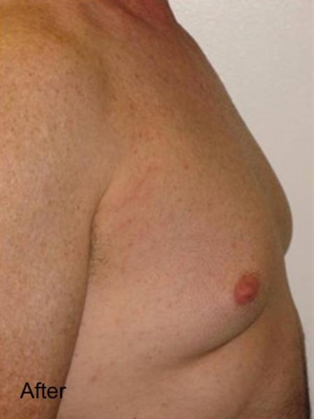 Gynecomastia Surgery after at Beverly Hills Aesthetics in Los Angeles, CA