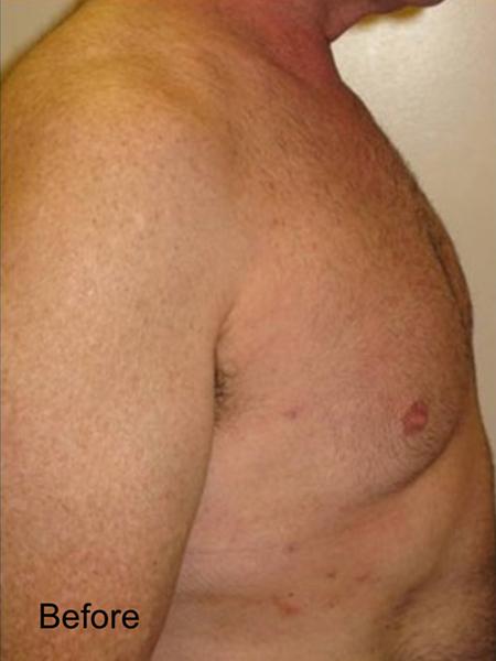 Gynecomastia Surgery before at Beverly Hills Aesthetics in Los Angeles, CA