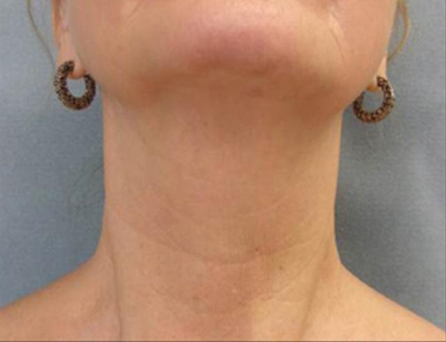 Neck Lift after at Beverly Hills Aesthetics in Los Angeles, CA