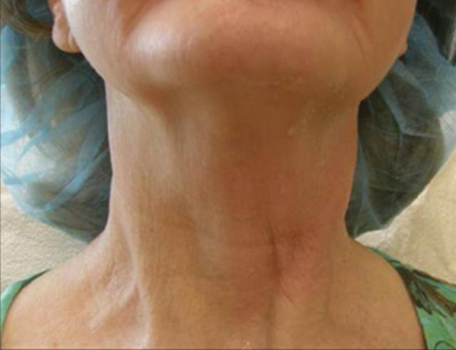 Neck Lift before at Beverly Hills Aesthetics in Los Angeles, CA