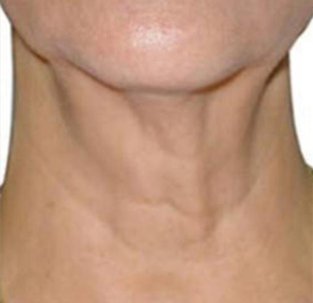 Microneedling after at Beverly Hills Aesthetics in Los Angeles, CA