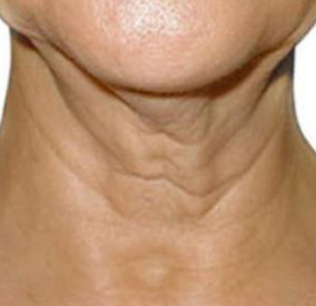 Microneedling before at Beverly Hills Aesthetics in Los Angeles, CA