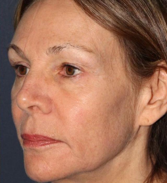 Deep Plane Facelift after at Beverly Hills Aesthetics in Los Angeles, CA