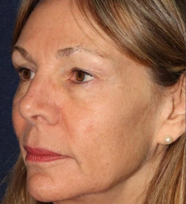 Deep Plane Facelift before at Beverly Hills Aesthetics in Los Angeles, CA