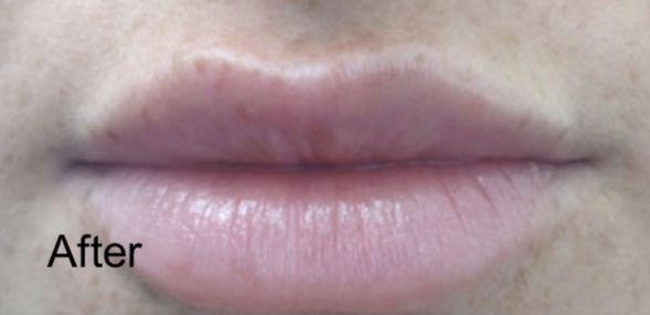 Lip Filler after at Beverly Hills Aesthetics in Los Angeles, CA