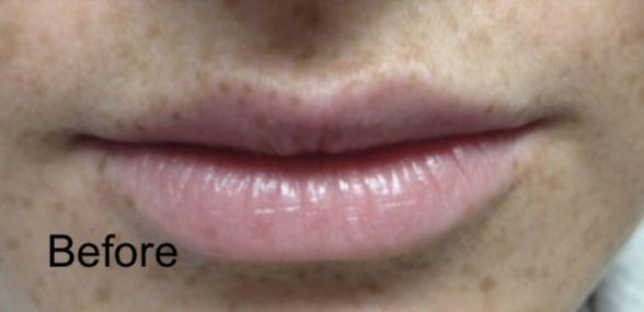 Lip Filler before at Beverly Hills Aesthetics in Los Angeles, CA
