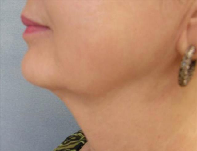 Kybella after at Beverly Hills Aesthetics in Los Angeles, CA