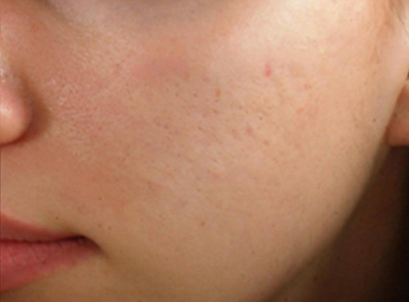 Beverly Hills Aesthetics microneedling after — Los Angeles, CA