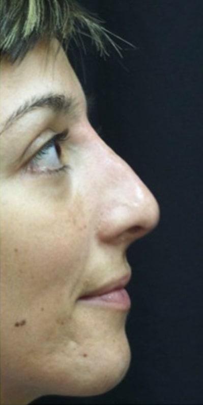 Functional Rhinoplasty after at Beverly Hills Aesthetics in Los Angeles, CA