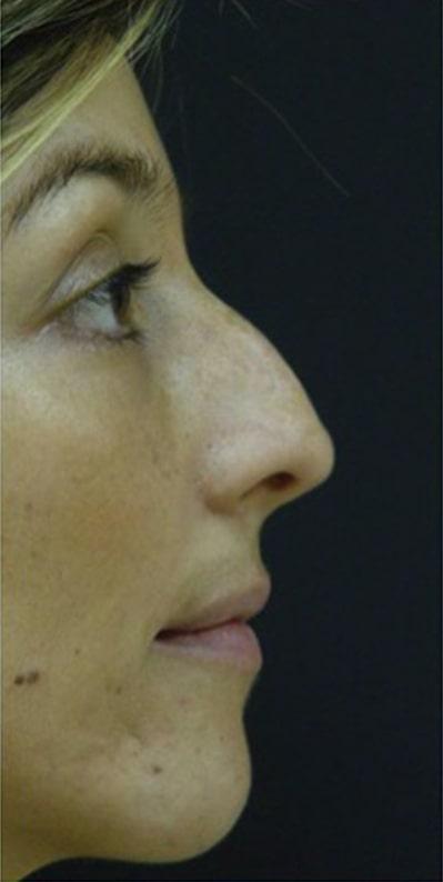 Functional Rhinoplasty before at Beverly Hills Aesthetics in Los Angeles, CA