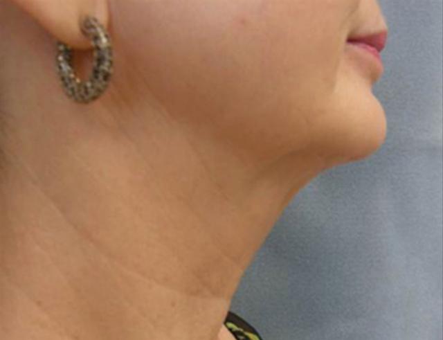 Neck Lift after at Beverly Hills Aesthetics in Los Angeles, CA