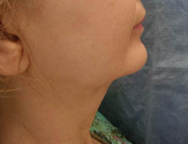 Neck Lift before at Beverly Hills Aesthetics in Los Angeles, CA