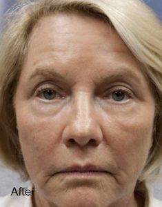 Laser Skin Resurfacing after at Beverly Hills Aesthetics in Los Angeles, CA