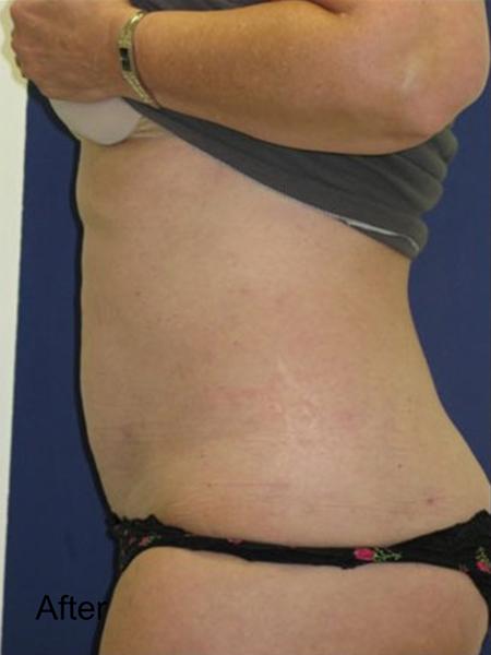 Tummy Tuck after at Beverly Hills Aesthetics in Los Angeles, CA