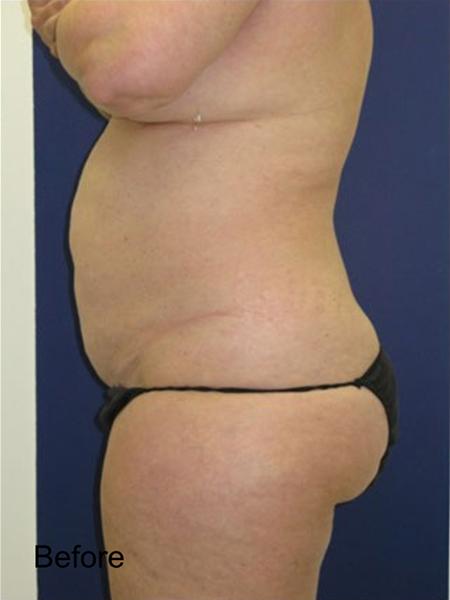 Tummy Tuck before at Beverly Hills Aesthetics in Los Angeles, CA